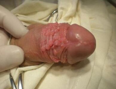 Papilloma in einem Mitglied