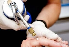 Methoden zur Entfernung von Hautpapillomen