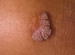 Humanes Papillomavirus Was ist das